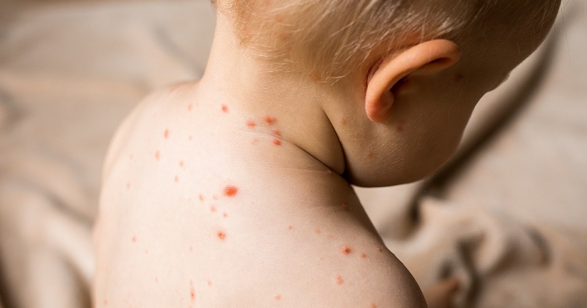 Najveća epidemija ospica u Europi u 30-ak godina. Razloga je više