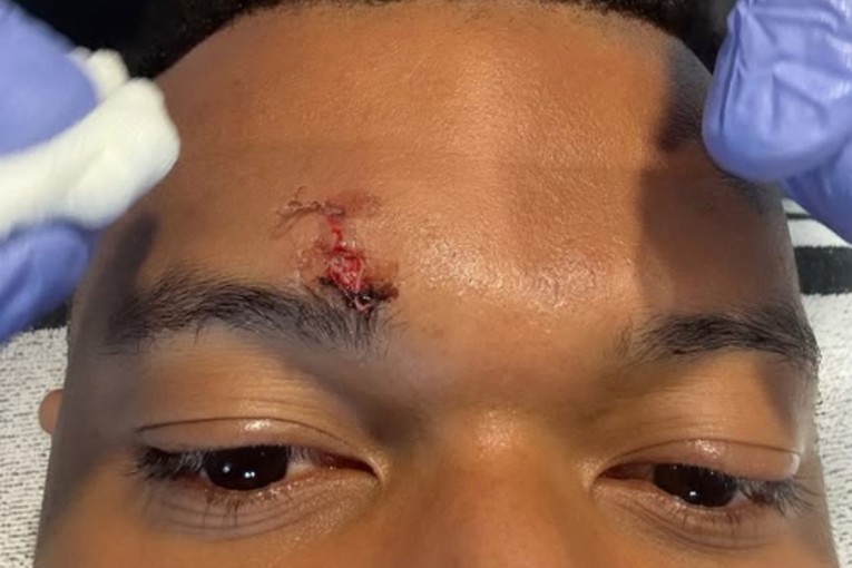 Mbappe objavio fotku. Pogledajte ozljedu za koju Real nije dobio penal