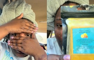 Žena dijeli upozorenje nakon što je viralni sapun od kurkume oštetio njezino lice