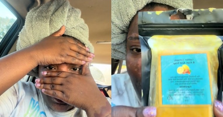 Žena dijeli upozorenje nakon što je viralni sapun od kurkume oštetio njezino lice