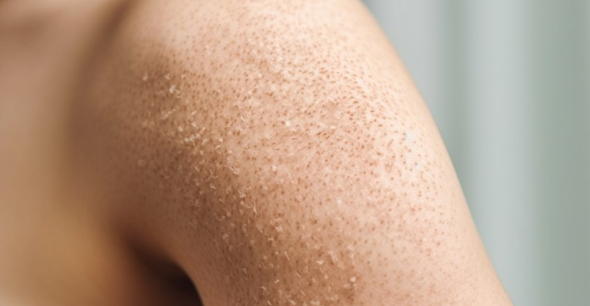 Jedan znak na koži mogao bi upozoriti da nam nedostaje vitamina C