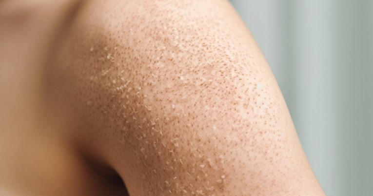 Jedan znak na koži mogao bi upozoriti da nam nedostaje vitamina C