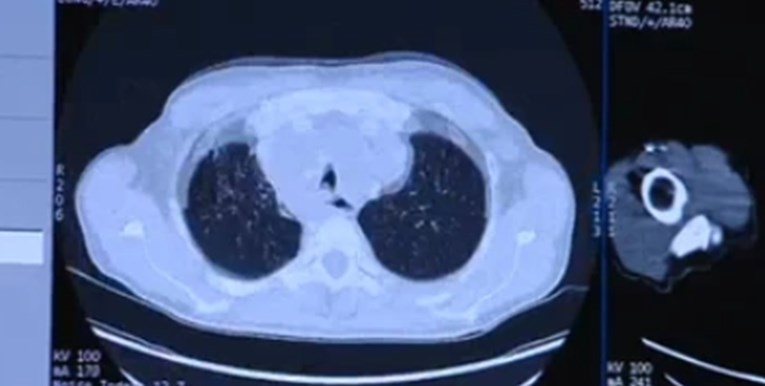 Velika nada za oboljele od raka pluća. U Hrvatskoj prvi put izveden težak zahvat