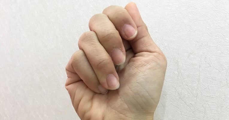 Što znače brazde na noktima i kad je vrijeme za odlazak liječniku?