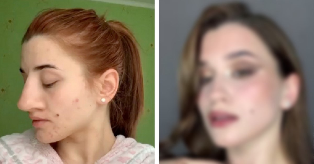 Djevojka pokazala izgled nakon operacije nosa, ljudi se čude transformaciji