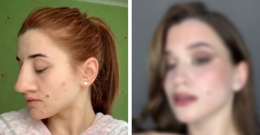 Djevojka pokazala izgled nakon operacije nosa, ljudi se čude transformaciji