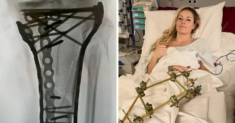 FOTO Vonn objavila rendgenske snimke. Operacija noge trajala je šest sati