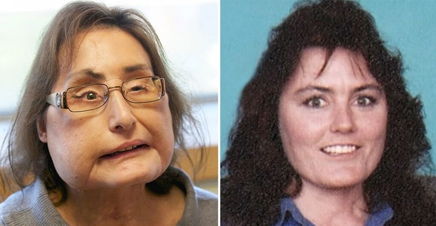 Preminula prva Amerikanka kojoj je transplantirano gotovo cijelo lice