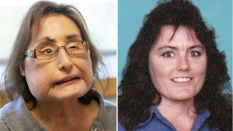 Preminula prva Amerikanka kojoj je transplantirano gotovo cijelo lice