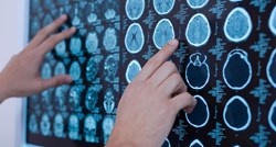 Sedam mogućih simptoma tumora na mozgu kojih moramo biti svjesni