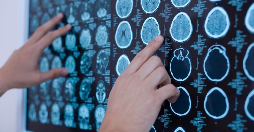 Sedam mogućih simptoma tumora na mozgu kojih moramo biti svjesni