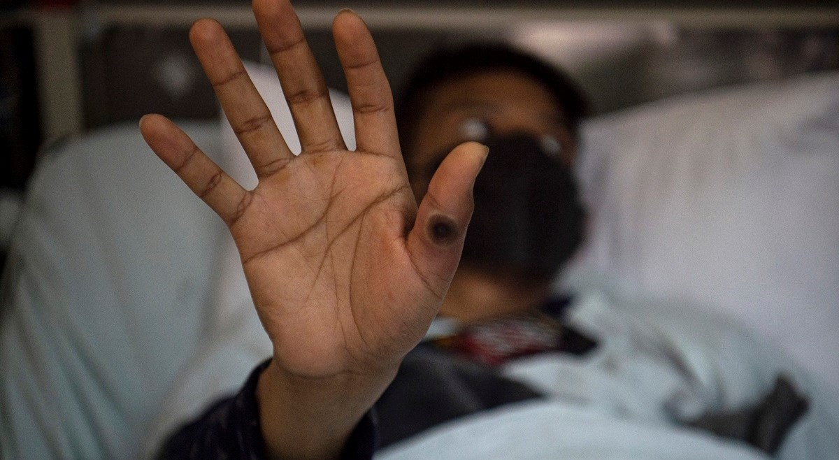 Epidemiologinja: Za djecu i trudnice majmunske boginje mogu biti opasne