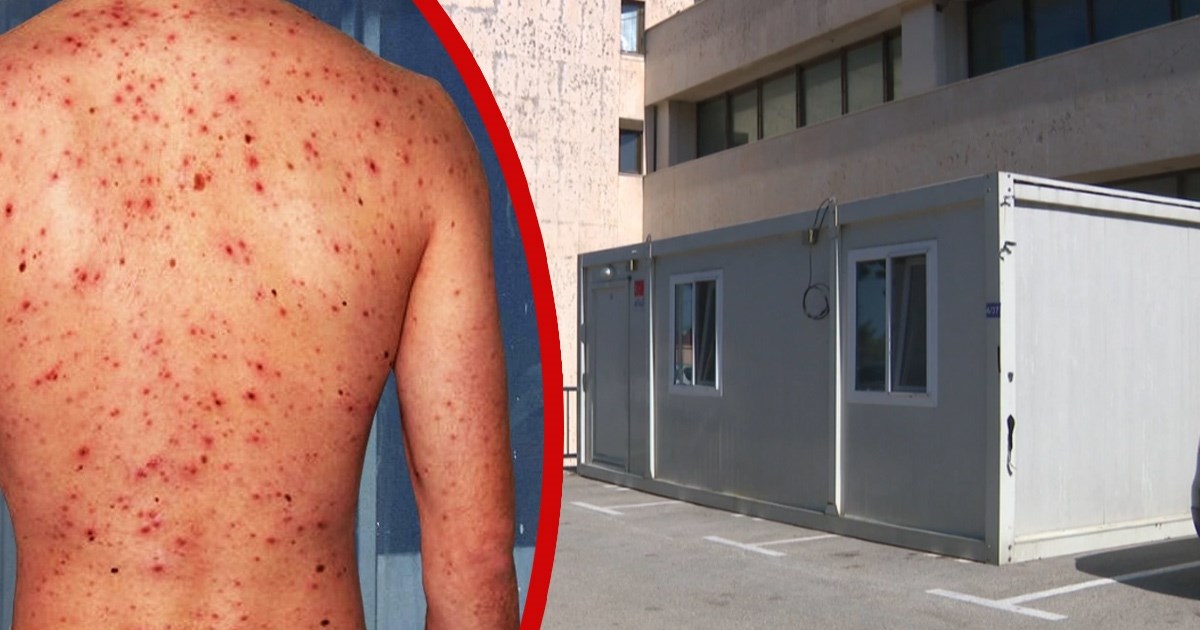 U Dubrovniku troje zaraženo ospicama, jedan slučaj sumnjiv. U BiH je epidemija