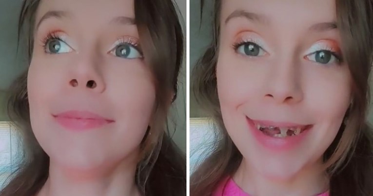 24-godišnjakinja ostala bez gotovo svih zuba jer si nije mogla priuštiti stomatologa