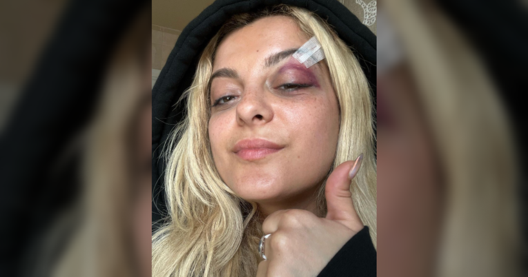 Bebe Rexha pokazala kako izgleda nakon što ju je netko pogodio mobitelom u glavu 