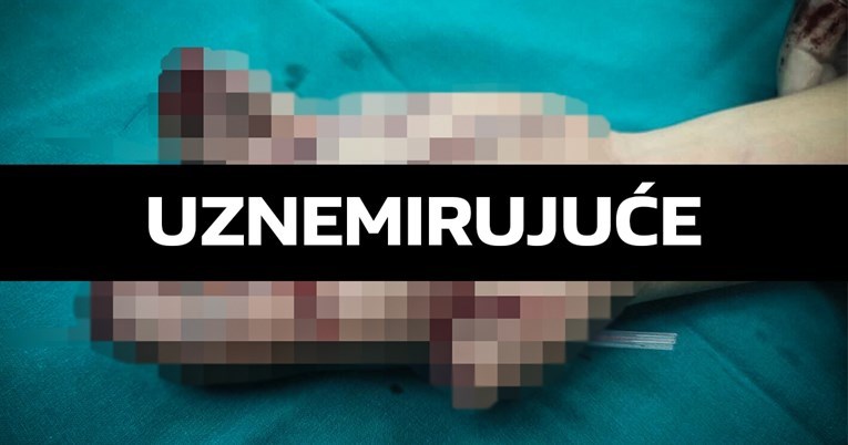 Dijete u Križevcima teško ozlijeđeno pirotehnikom, policija istražuje