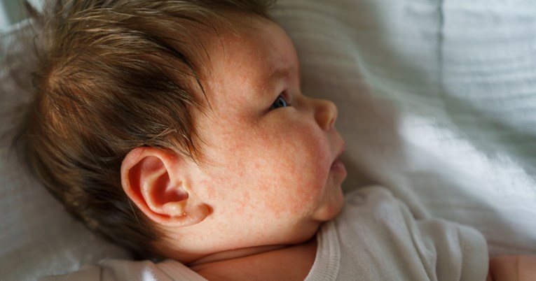 Dermatologinja za Index: Ovo su prvi znakovi da dijete ima atopijski dermatitis