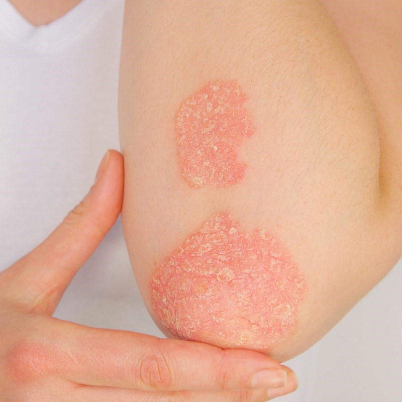 Udubljenja na noktima, promjene na vlasištu, svrbež... Ovo su simptomi psorijaze