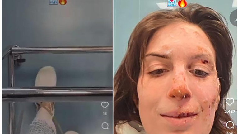 Eleonora je preživjela požar u švicarskom baru, objavila slike iz bolnice