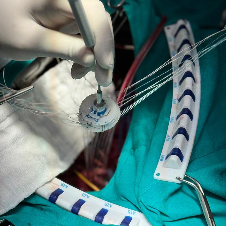 Najnoviji biološki zalisak po prvi put ugrađen u splitskoj bolnici