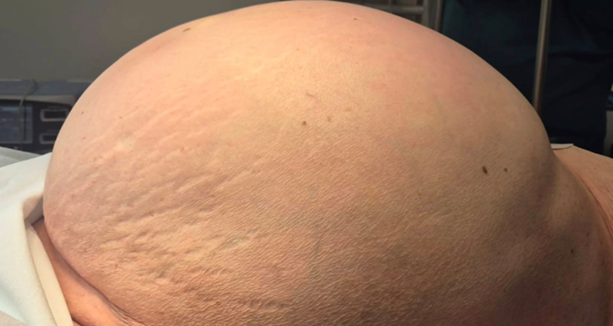 Ani (81) uklonili golemi tumor: "Ne jedem ništa od podne do navečer, a trbuh raste"