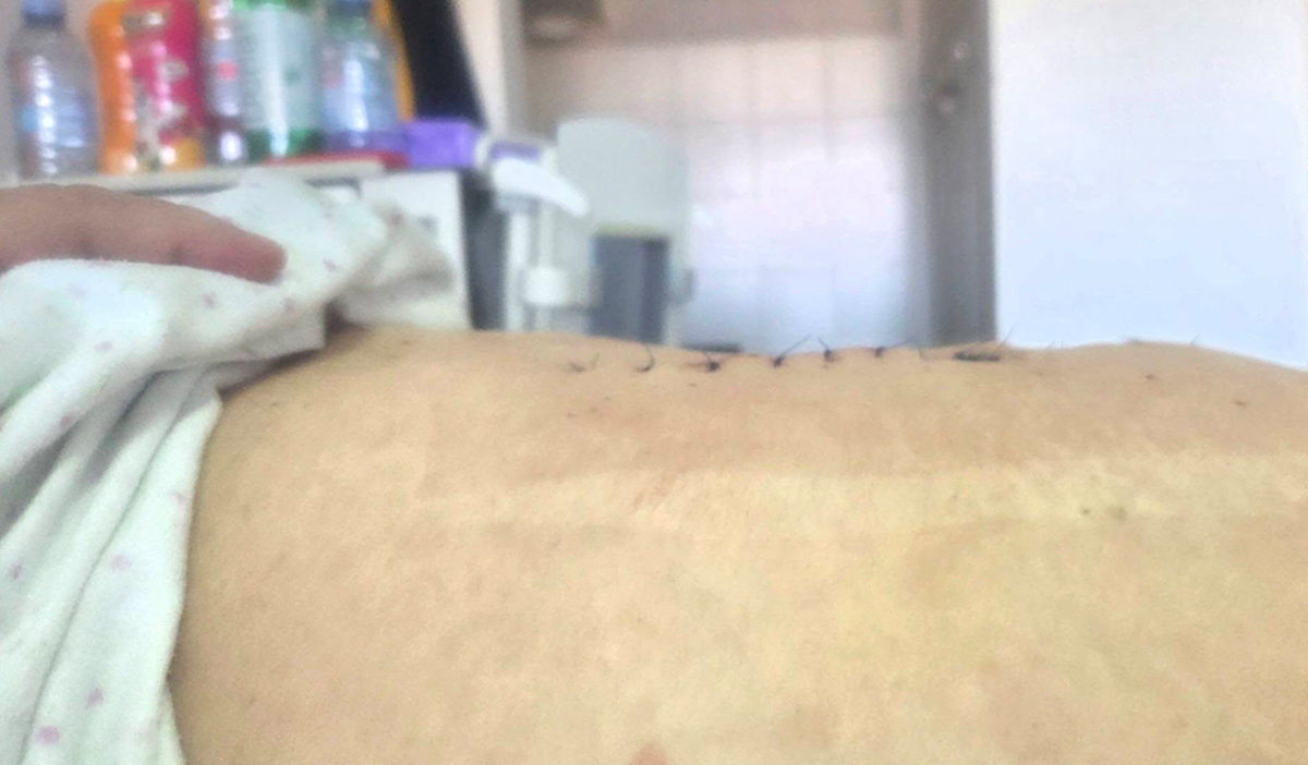 Ani (81) uklonili golemi tumor: "Ne jedem ništa od podne do navečer, a trbuh raste"