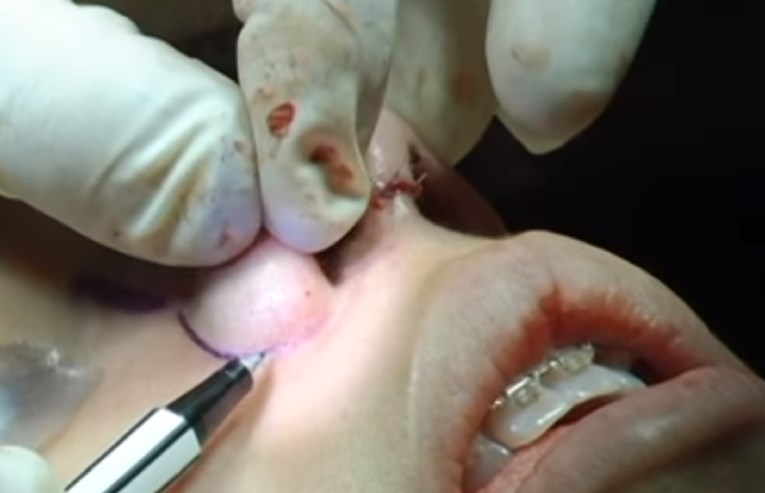 Slovenski kirurzi uzgojili nos na ženinoj nadlaktici i presadili joj ga na lice