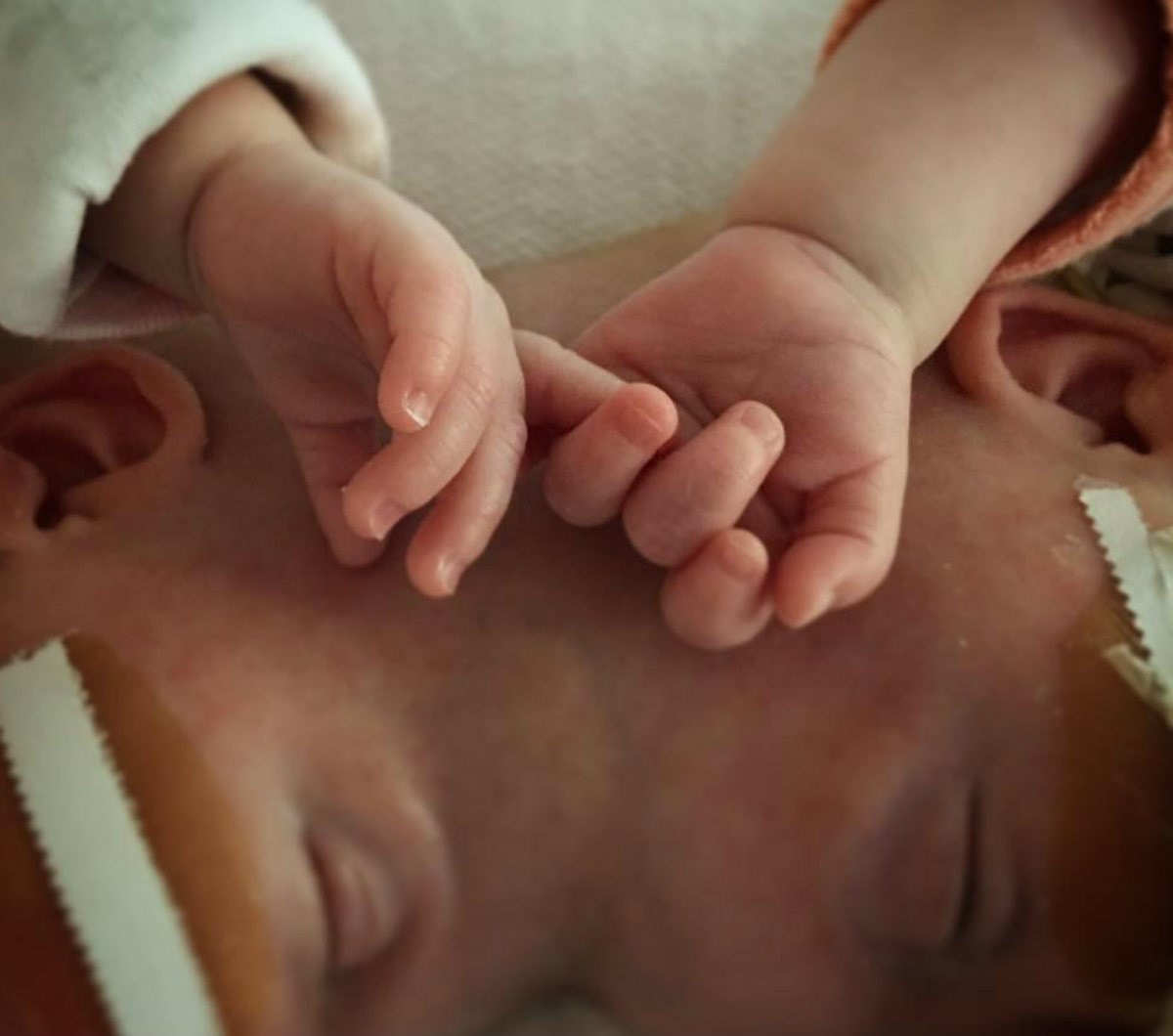 Nakon što su im razdvojili glavice mama izjavila: "Sada se moram naviknuti da imam dvije kćeri"