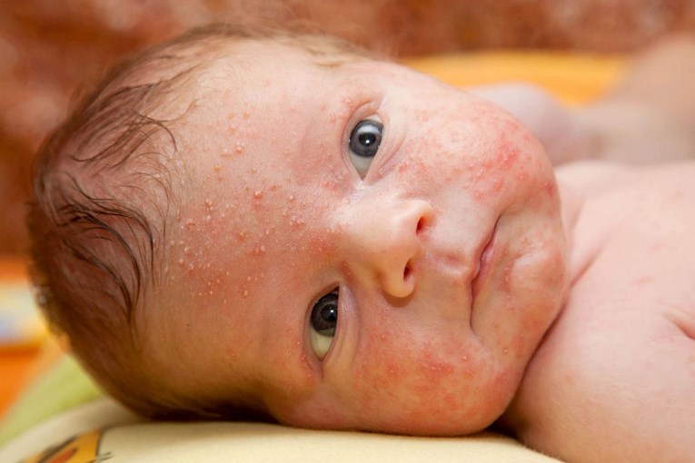 Što činiti kad bebi izbiju bubuljice po licu i tijelu?