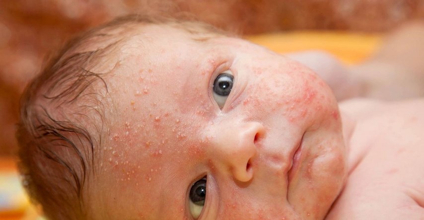Što činiti kad bebi izbiju bubuljice po licu i tijelu?