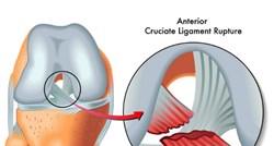 Ozljeda prednjeg križnog ligamenta