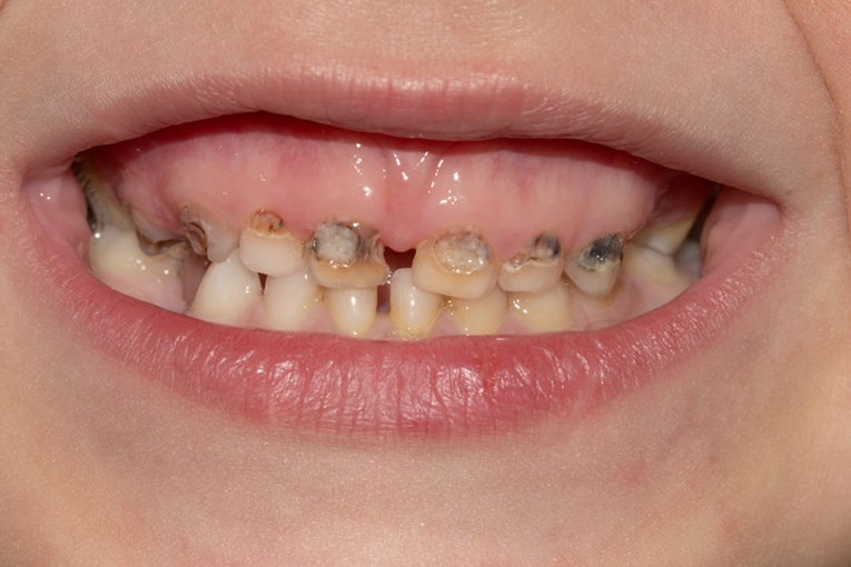 Roditelji bi trebali prati djeci zube sve do puberteta!