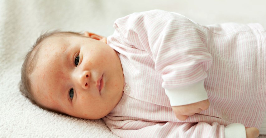 Trebaju li vas plašiti akne kod beba?