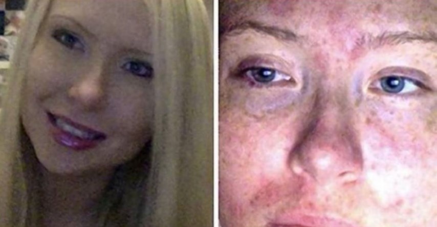 Sve je moguće: Upoznajte ženu koja je alergična na vlastiti znoj