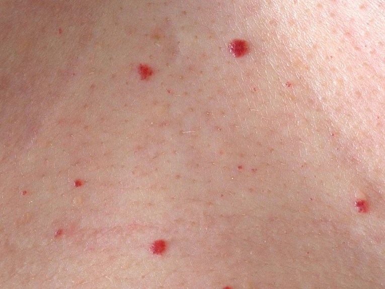 Imate ovakve crvene točkice po koži? Provjerite o čemu je riječ i jesu li opasne