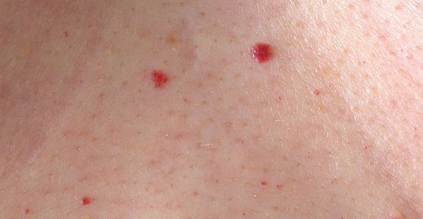 Imate ovakve crvene točkice po koži? Provjerite o čemu je riječ i jesu li opasne