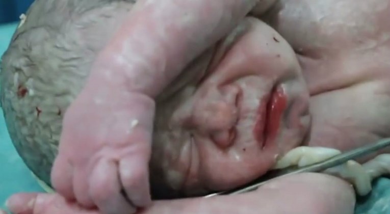 Pogledajte kako su liječnici u Siriji uspjeli spasiti bebin život