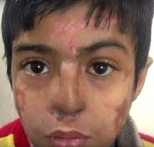 Liječnici u Indiji uzgojili novi nos na dječakovu čelu