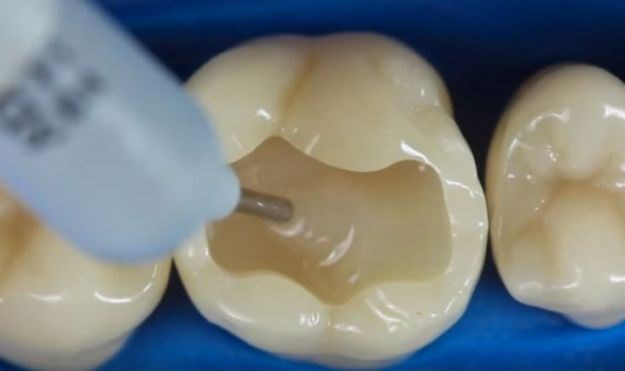 Video popravka goleme rupetine na zubu je sve što danas želite vidjeti