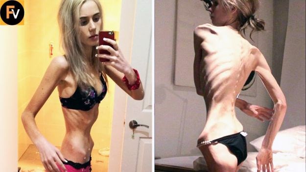 Ugrožena je cijela generacija: Ovo je osam najšokantnijih slučajeva anoreksije