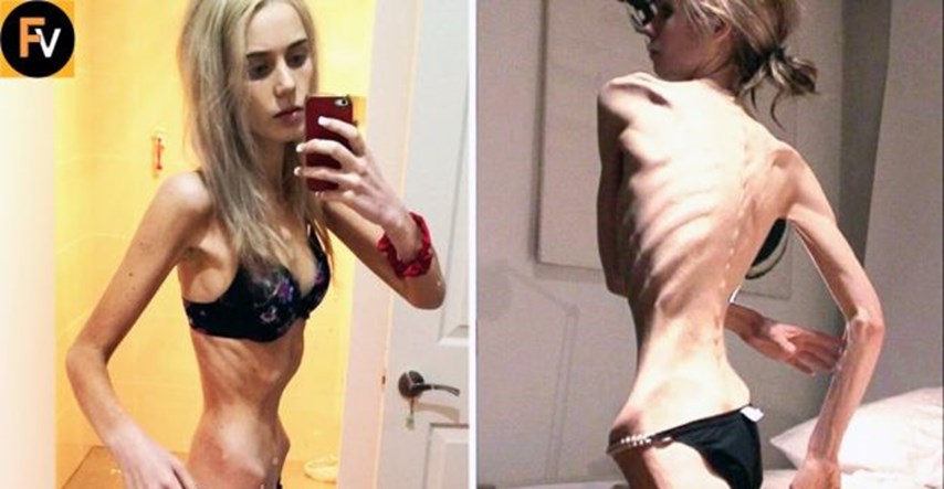 Ugrožena je cijela generacija: Ovo je osam najšokantnijih slučajeva anoreksije