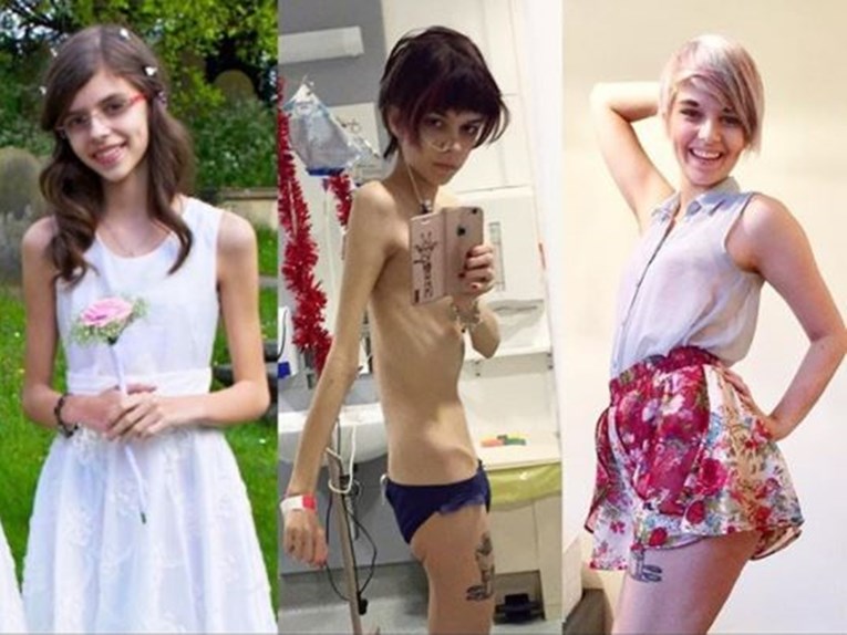 FOTO Snimala je proces oporavka od anoreksije, fotke su i jezive i dirljive