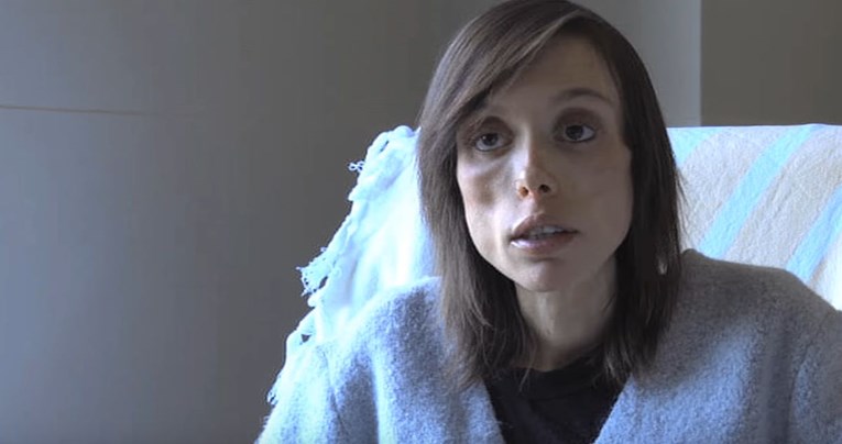 VIDEO Ova djevojka se već 15 godina bori s anoreksijom: "Nemam kontrolu nad tim"