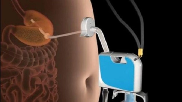 Odobreno je korištenje uređaja koji izbacuje hranu iz želuca netom nakon obroka!