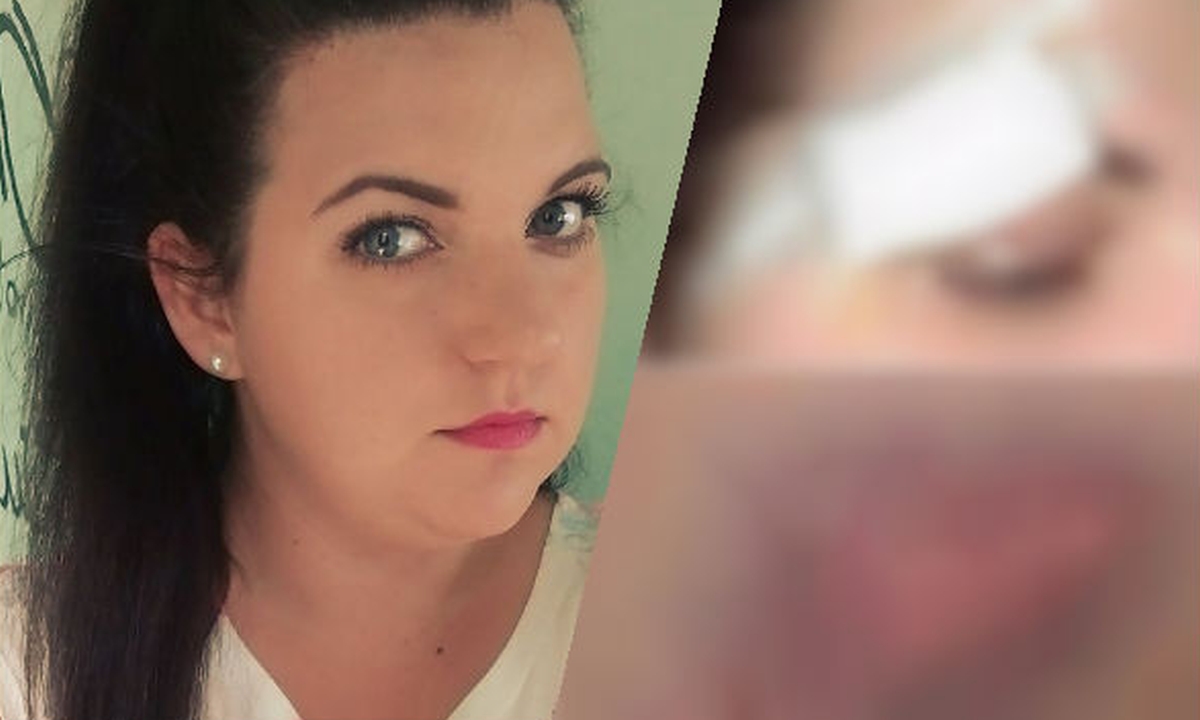 FOTO Barbi iz "Farme" otkrila kako ju je pretukao bivši dečko: "Ostavio me u krvi da ležim na cesti"