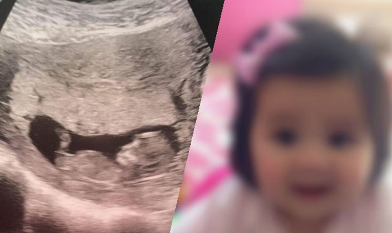Ultrazvuk ove bebe iznenadio je liječnike, a kad se rodila, njena mama nije mogla vjerovati što vidi