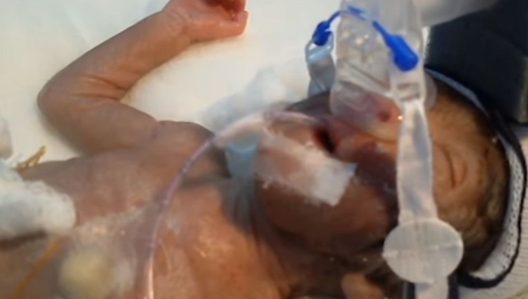 VIDEO Mali heroj: Najmanji dječak na svijetu preživio operaciju srca