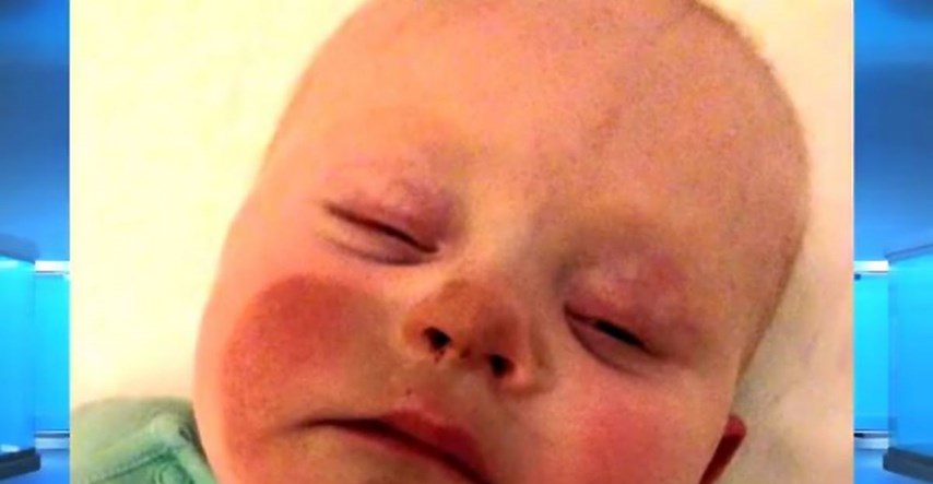 Mame, pripazite što radite: Beba nakon dojenja dobila čudne mrlje na licu