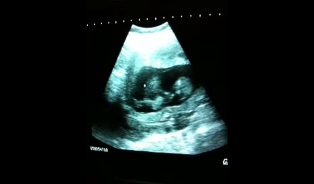 Živahna beba: Najluđa snimka ultrazvuka