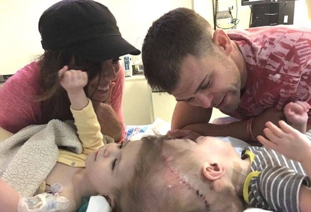 Razdvojeni sijamski blizanci spojeni na vrhu glave: "Sad imaju šansu za normalan život"